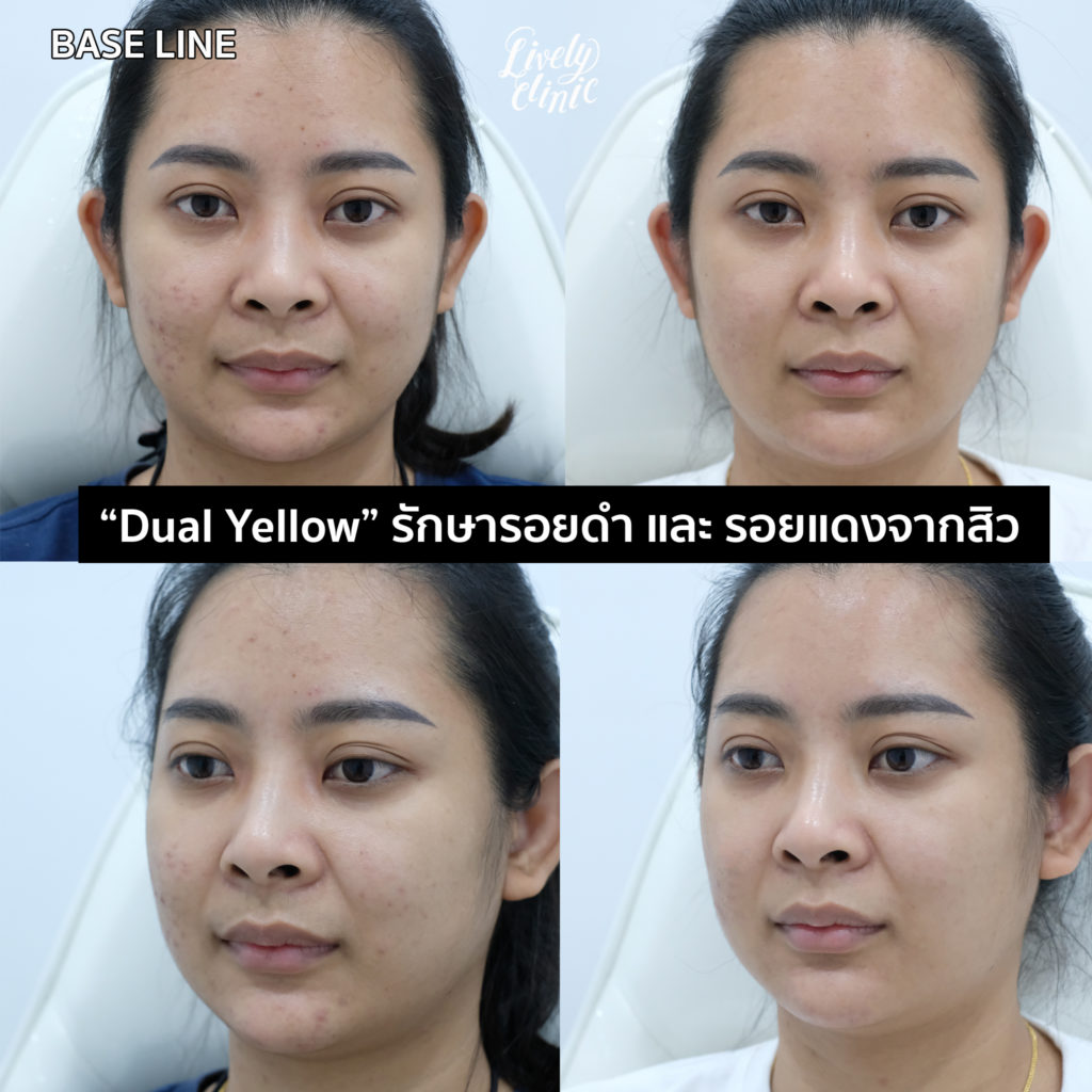 Dual Yellow