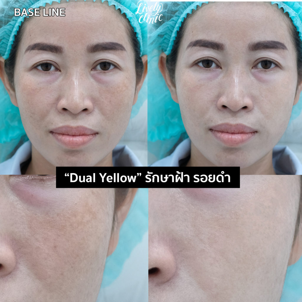 Dual Yellow